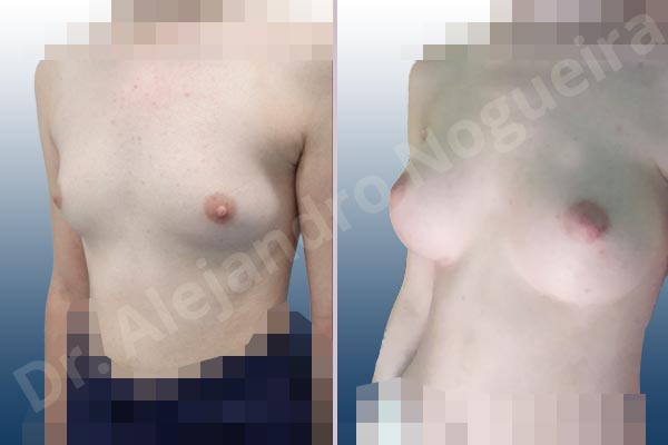 Empty breasts,Lateral breasts,Narrow breasts,Skinny breasts,Small breasts,Too far apart wide cleavage breasts,Anatomical shape,Inframammary incision,Subfascial pocket plane - photo 3
