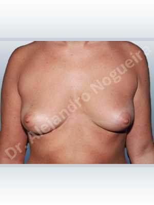Empty breasts,Lateral breasts,Mildly saggy droopy breasts,Moderately saggy droopy breasts,Slightly large breasts,Tuberous breasts,Wide breasts,Lower hemi periareolar incision,Round shape,Subfascial pocket plane,Tuberous mammoplasty,Extra large size