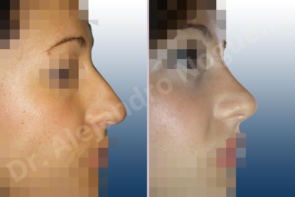 Broad dorsum,Broad nose,Crooked nose,Dorsum hump,Dorsum ridges,Droopy tip,Dynamic alar flaring,Large alar cartilages,Large nose,Long nose,Long upper lateral cartilages,Mediterranean nose,Overprojected tip,Plunging tip deformity,Closed approach incision,Dorsum hump resection,Lateral cruras cephalic resection,Lateral cruras shortening resection,Medial cruras shortening resection,Nasal bones osteotomies,Triangular cartilages caudal resection - photo 4