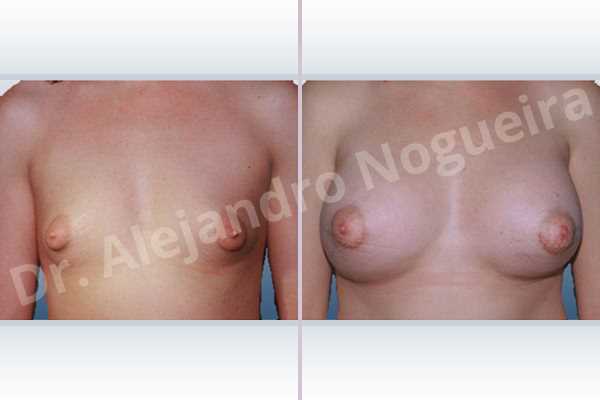 Asymmetric breasts,Cross eyed breasts,Large areolas,Lateral breasts,Narrow breasts,Small breasts,Too far apart wide cleavage breasts,Tuberous breasts,Anatomical shape,Areola reduction,Circumareolar incision,Subfascial pocket plane,Tuberous mammoplasty - photo 1