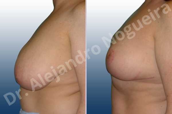 Cross eyed breasts,Extremely saggy droopy breasts,Lateral breasts,Pendulous breasts,Severely large breasts,Severely saggy droopy breasts,Tuberous breasts,Wide breasts,Anchor incision,Double vertical pedicle - photo 2