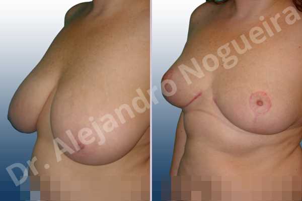 Cross eyed breasts,Extremely saggy droopy breasts,Lateral breasts,Pendulous breasts,Severely large breasts,Severely saggy droopy breasts,Tuberous breasts,Wide breasts,Anchor incision,Double vertical pedicle - photo 3