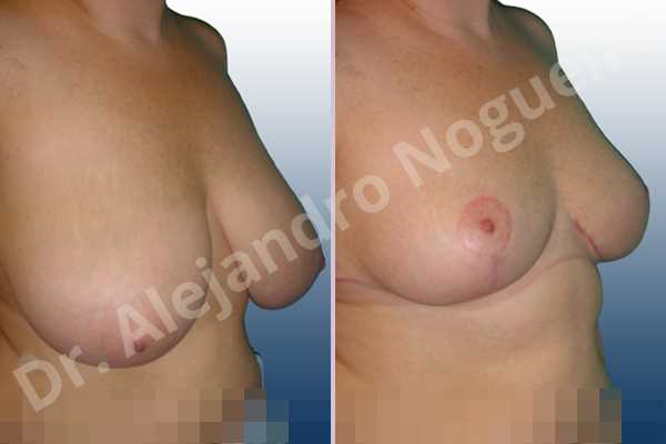 Cross eyed breasts,Extremely saggy droopy breasts,Lateral breasts,Pendulous breasts,Severely large breasts,Severely saggy droopy breasts,Tuberous breasts,Wide breasts,Anchor incision,Double vertical pedicle - photo 5
