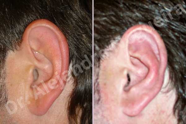 Prominent ears,Mustardé antihelical suturing - photo 1