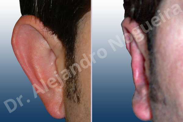 Prominent ears,Mustardé antihelical suturing - photo 4