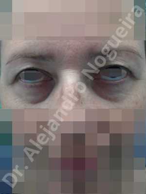 Baggy lower eyelids,Baggy upper eyelids,Saggy upper eyelids,Lower eyelid fat bags resection,Transconjunctival approach incision,Upper eyelid fat bags resection,Upper eyelid skin and muscle resection