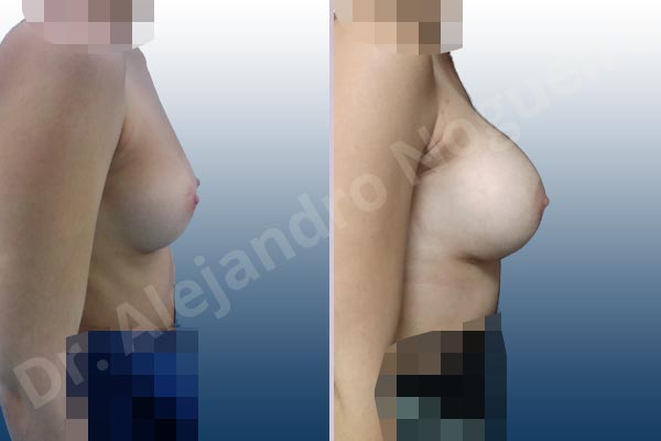 Empty breasts,Narrow breasts,Small breasts,Inframammary incision,Round shape,Subfascial pocket plane - photo 4