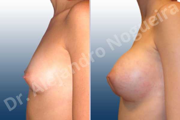 Asymmetric breasts,Empty breasts,Lateral breasts,Narrow breasts,Skinny breasts,Small breasts,Too far apart wide cleavage breasts,Inframammary incision,Round shape,Subfascial pocket plane - photo 2
