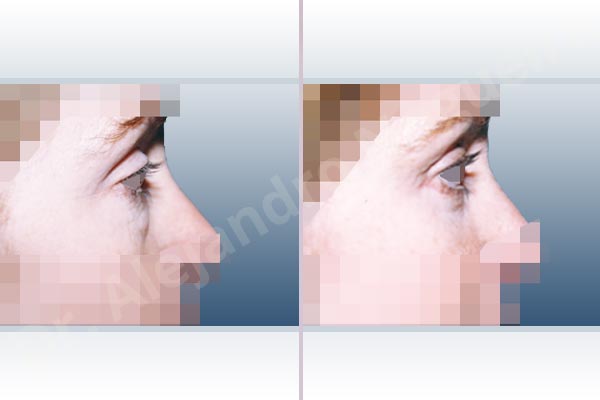 Baggy lower eyelids,Saggy upper eyelids,Lower eyelid fat bags resection,Transconjunctival approach incision,Upper eyelid skin and muscle resection - photo 3