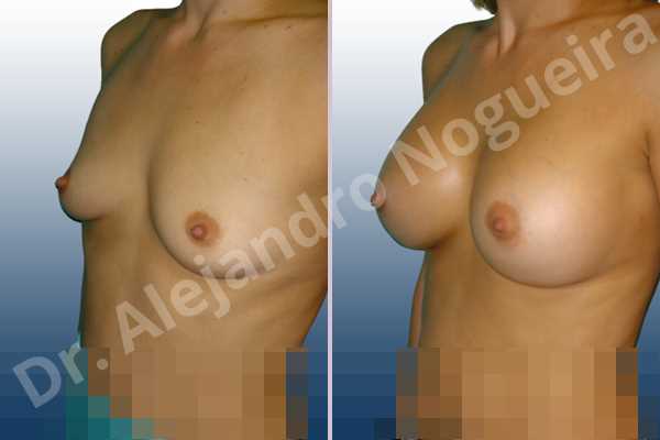 Empty breasts,Slightly saggy droopy breasts,Small breasts,Too far apart wide cleavage breasts,Anatomical shape,Lower hemi periareolar incision,Subfascial pocket plane - photo 3