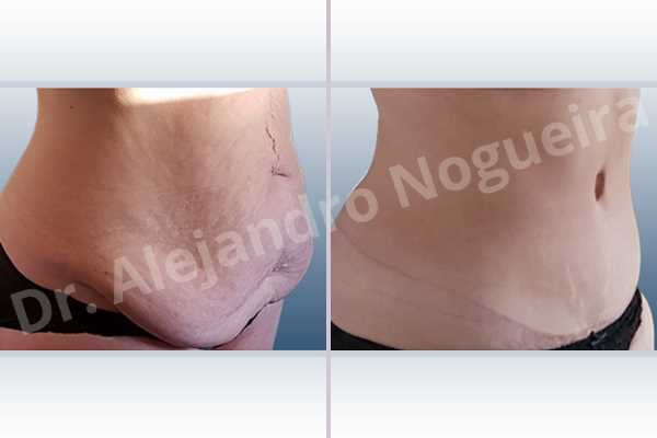 Saggy abdomen,Weak abdomen muscles,Standard abdominoplasty - photo 11