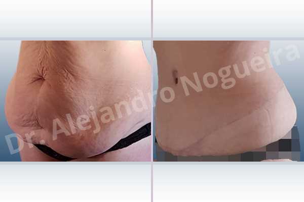 Saggy abdomen,Weak abdomen muscles,Standard abdominoplasty - photo 7