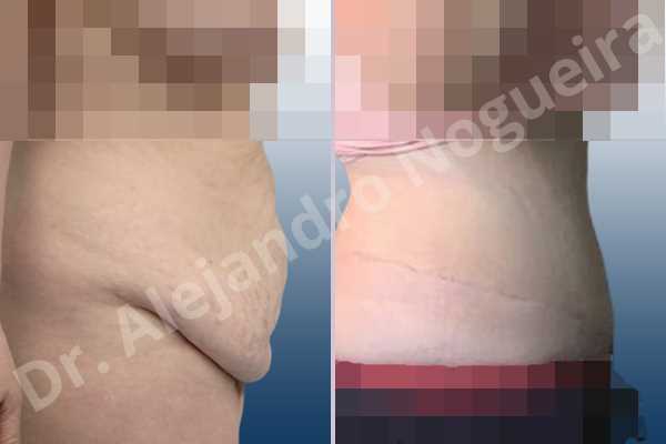 Saggy abdomen,Weak abdomen muscles,Standard abdominoplasty - photo 8