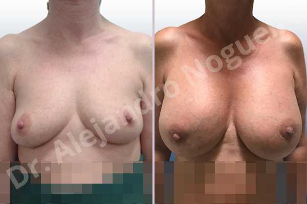 Empty breasts,Lateral breasts,Mildly saggy droopy breasts,Small breasts,Too far apart wide cleavage breasts,Wide breasts,Anatomical shape,Lower hemi periareolar incision,Subfascial pocket plane - photo 1