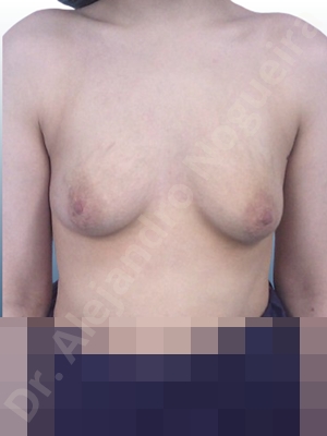 Asymmetric breasts,Cross eyed breasts,Empty breasts,Lateral breasts,Sunken chest,Too far apart wide cleavage breasts,Tuberous breasts,Anatomical shape,Lower hemi periareolar incision,Subfascial pocket plane,Tuberous mammoplasty