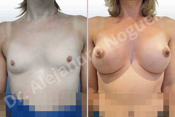 Cross eyed breasts,Empty breasts,Lateral breasts,Narrow breasts,Skinny breasts,Small breasts,Sunken chest,Too far apart wide cleavage breasts,Transgender breasts,Anatomical shape,Inframammary incision,Subfascial pocket plane - photo 1