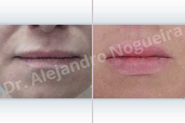 Small lips,Lower lip autologous dermis collagen filler,Upper lip autologous dermis collagen filler - photo 1