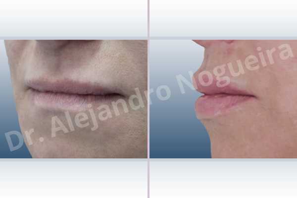 Small lips,Lower lip autologous dermis collagen filler,Upper lip autologous dermis collagen filler - photo 3