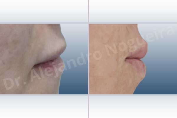 Small lips,Lower lip autologous dermis collagen filler,Upper lip autologous dermis collagen filler - photo 4