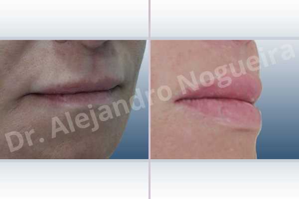 Small lips,Lower lip autologous dermis collagen filler,Upper lip autologous dermis collagen filler - photo 5