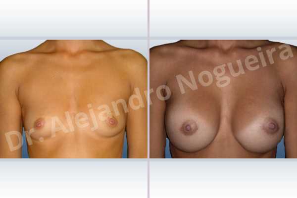 Lateral breasts,Narrow breasts,Skinny breasts,Small breasts,Sunken chest,Too far apart wide cleavage breasts,Anatomical shape,Lower hemi periareolar incision,Subfascial pocket plane - photo 1