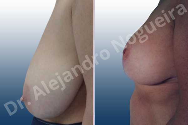 Asymmetric breasts,Breast tissue bottoming out,Extremely saggy droopy breasts,Large areolas,Pendulous breasts,Severely large breasts,Anchor incision,Areola reduction,Double vertical pedicle - photo 2