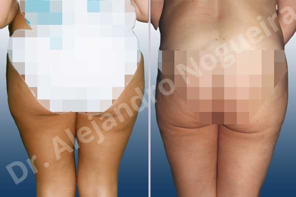 Saddle bags flab,Tumescent liposuction - photo 2