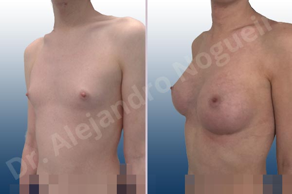 Lateral breasts,Narrow breasts,Skinny breasts,Small breasts,Too far apart wide cleavage breasts,Transgender breasts,Anatomical shape,Inframammary incision,Subfascial pocket plane - photo 3