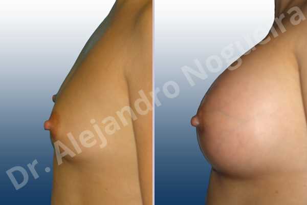 Asymmetric breasts,Empty breasts,Lateral breasts,Small breasts,Too far apart wide cleavage breasts,Wide breasts,Anatomical shape,Extra large size,Lower hemi periareolar incision,Subfascial pocket plane - photo 2