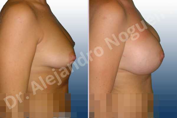 Asymmetric breasts,Cross eyed breasts,Empty breasts,Mildly saggy droopy breasts,Moderately saggy droopy breasts,Small breasts,Too far apart wide cleavage breasts,Tuberous breasts,Lower hemi periareolar incision,Round shape,Subfascial pocket plane,Tuberous mammoplasty - photo 4