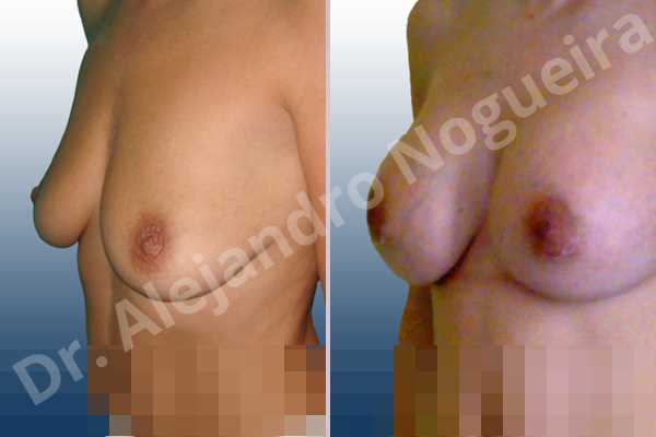 Empty breasts,Mildly saggy droopy breasts,Slightly saggy droopy breasts,Small breasts,Anatomical shape,Extra large size,Lower hemi periareolar incision,Subfascial pocket plane - photo 3