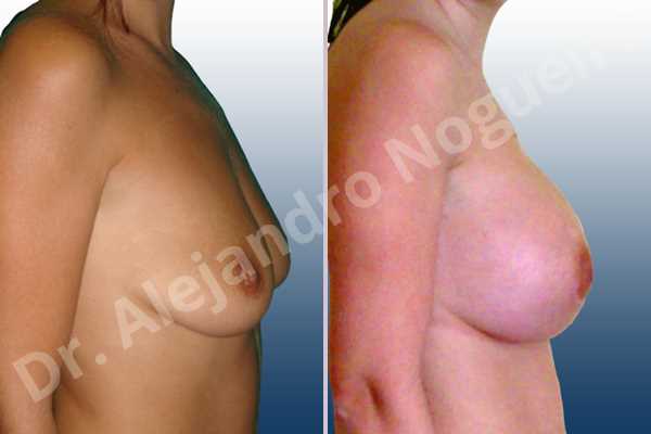 Empty breasts,Mildly saggy droopy breasts,Slightly saggy droopy breasts,Small breasts,Anatomical shape,Extra large size,Lower hemi periareolar incision,Subfascial pocket plane - photo 4
