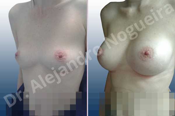 Breast implants symmastia uniboob,Cross eyed breasts,Empty breasts,Small breasts,Anatomical shape,Lower hemi periareolar incision,Subfascial pocket plane - photo 3