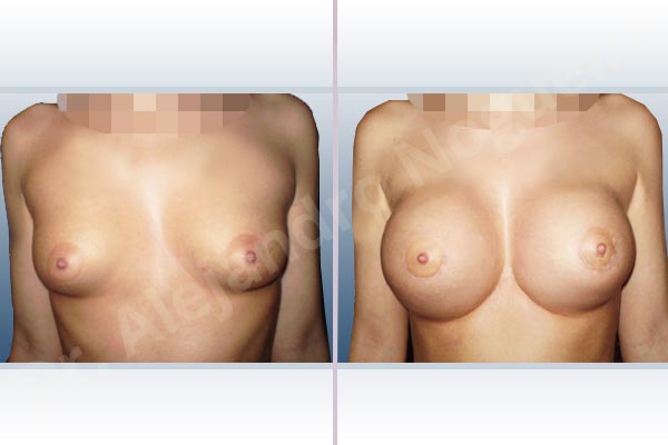 Cross eyed breasts,Empty breasts,Lateral breasts,Narrow breasts,Skinny breasts,Small breasts,Sunken chest,Too far apart wide cleavage breasts,Tuberous breasts,Extra large size,Lower hemi periareolar incision,Round shape,Subfascial pocket plane,Tuberous mammoplasty - photo 1