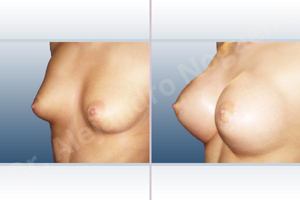Cross eyed breasts,Empty breasts,Lateral breasts,Narrow breasts,Skinny breasts,Small breasts,Sunken chest,Too far apart wide cleavage breasts,Tuberous breasts,Extra large size,Lower hemi periareolar incision,Round shape,Subfascial pocket plane,Tuberous mammoplasty - photo 3