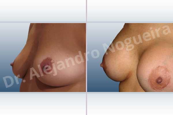 Asymmetric breasts,Empty breasts,Slightly saggy droopy breasts,Small breasts,Lower hemi periareolar incision,Round shape,Subfascial pocket plane - photo 3