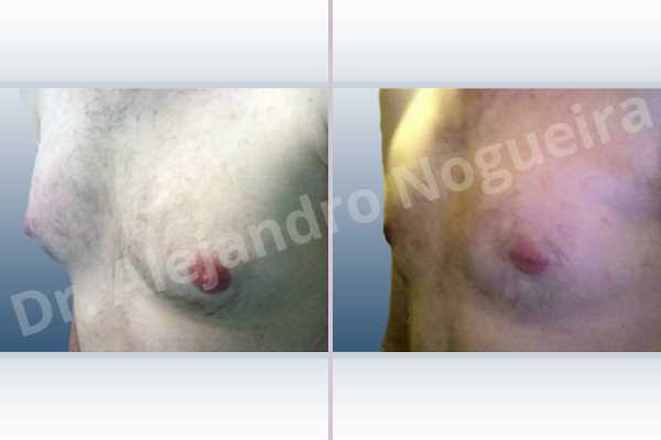 Gynecomastia,Subcutaneous mastectomy,Transareolar incision - photo 3