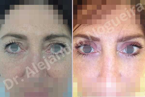 Baggy upper eyelids,Saggy upper eyelids,Upper eyelid fat bags resection,Upper eyelid skin and muscle resection - photo 1