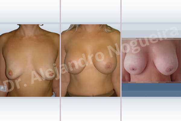 Empty breasts,Lateral breasts,Moderately large breasts,Pigeon chest,Small breasts,Too far apart wide cleavage breasts,Wide breasts,Dual plane pocket,Lower hemi periareolar incision,Round shape - photo 1