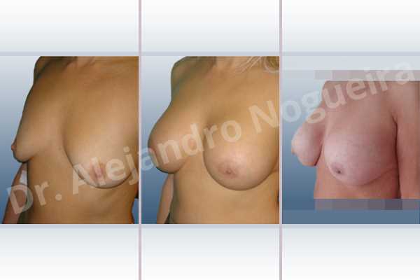 Empty breasts,Lateral breasts,Moderately large breasts,Pigeon chest,Small breasts,Too far apart wide cleavage breasts,Wide breasts,Dual plane pocket,Lower hemi periareolar incision,Round shape - photo 3