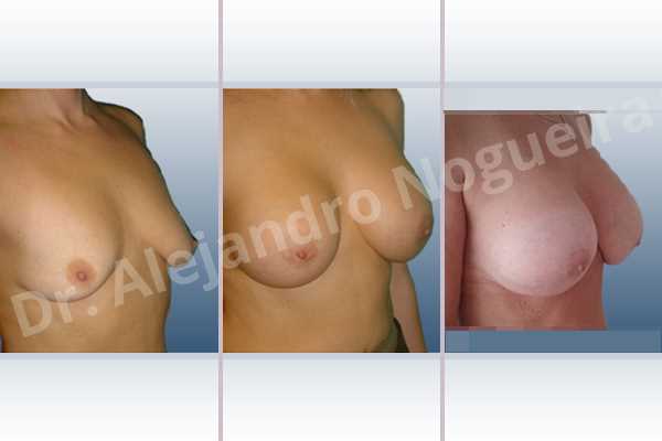 Empty breasts,Lateral breasts,Moderately large breasts,Pigeon chest,Small breasts,Too far apart wide cleavage breasts,Wide breasts,Dual plane pocket,Lower hemi periareolar incision,Round shape - photo 5