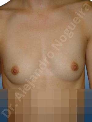 Lateral breasts,Narrow breasts,Pigeon chest,Skinny breasts,Small breasts,Too far apart wide cleavage breasts,Inframammary incision,Round shape,Subfascial pocket plane