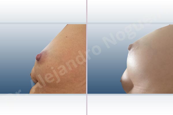 Asymmetric breasts,Cross eyed breasts,Empty breasts,Slightly saggy droopy breasts,Small breasts,Anatomical shape,Lower hemi periareolar incision,Subfascial pocket plane - photo 2