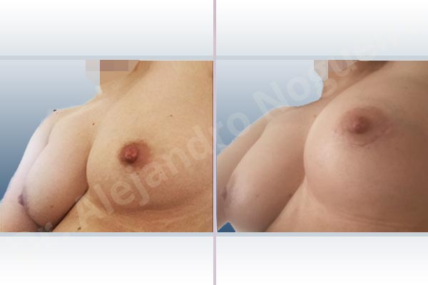Asymmetric breasts,Cross eyed breasts,Empty breasts,Slightly saggy droopy breasts,Small breasts,Anatomical shape,Lower hemi periareolar incision,Subfascial pocket plane - photo 3