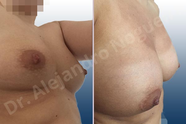 Asymmetric breasts,Cross eyed breasts,Empty breasts,Slightly saggy droopy breasts,Small breasts,Anatomical shape,Lower hemi periareolar incision,Subfascial pocket plane - photo 5