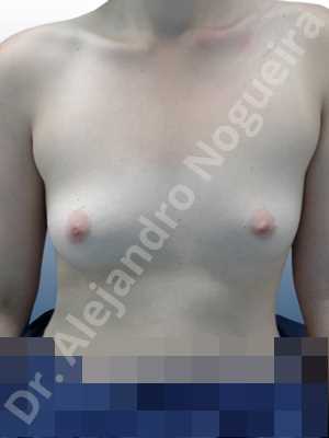 Asymmetric breasts,Empty breasts,Small breasts,Sunken chest,Wide breasts,Inframammary incision,Round shape,Subfascial pocket plane