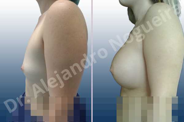 Asymmetric breasts,Empty breasts,Small breasts,Sunken chest,Wide breasts,Inframammary incision,Round shape,Subfascial pocket plane - photo 2