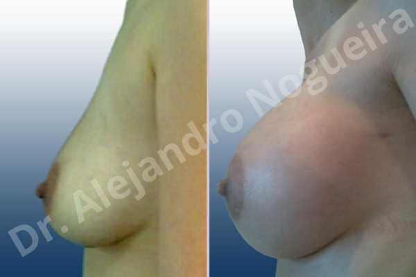 Asymmetric breasts,Empty breasts,Moderately saggy droopy breasts,Small breasts,Extra large size,Lower hemi periareolar incision,Round shape,Subfascial pocket plane - photo 2