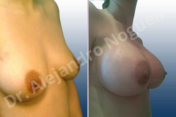 Asymmetric breasts,Empty breasts,Moderately saggy droopy breasts,Small breasts,Extra large size,Lower hemi periareolar incision,Round shape,Subfascial pocket plane - photo 5