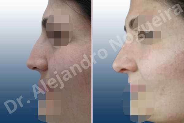 Alar rim retraction,Andine nose,Arabic nose,Asian nose,Asymmetric nose,Asymmetric tip,Bifid tip,Concave lateral cruras,Congenital nose,Crooked nose,Dorsum hump,Dorsum ridges,Hispanic nose,Humpless dorsum,Jewish nose,Low radix,Mixed race blood,Narrow dorsum,Narrow nose,Overrotated tip,Pinched middle vault,Pinched nose,Pointy tip,Poorly supported tip,Rhomboid dorsum,Short nose,Short septum,Short upper lateral cartilages,Small alar cartilages,Small nose,Sunken columella,Sunken supratip,Tension nose,Thin skin nose,Underprojected tip,Columella lengthening,Custom made tip graft,Dorsum hump resection,Dorsum plateau resection,Ear cartilage graft harvesting,Extended shield tip columella graft,Intercrural columella plasty sutures,Interdomal tip plasty sutures,Lateral cruras batten graft,Lateral cruras caudal extension graft,Lateral cruras custom made graft,Lateral cruras lengthening graft,Lateral cruras replacement graft,Lateral cruras repositioning,Medial cruras custom made graft,Nasal bones osteotomies,Onlay columella graft,Onlay supratip graft,Onlay tip graft,Open approach incision,Shield tip graft,Spreader graft,Temporalis fascia graft harvesting,Tip replacement graft,Triangular cartilages caudal extension graft - photo 3